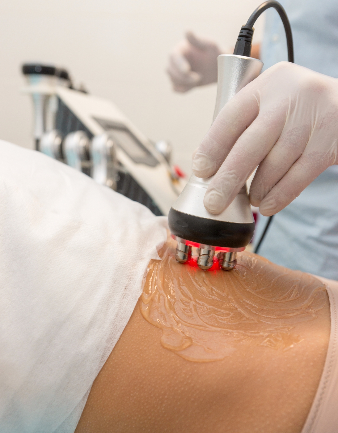 radio frequency skin tightening.jpg (1)